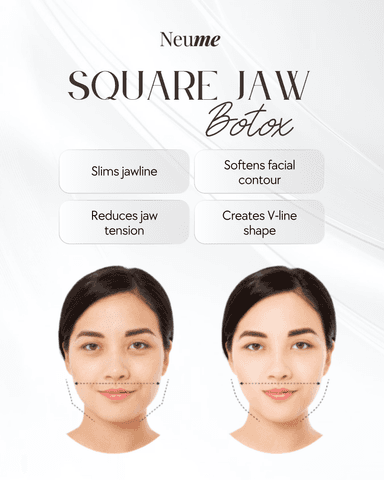 Jaw Botox