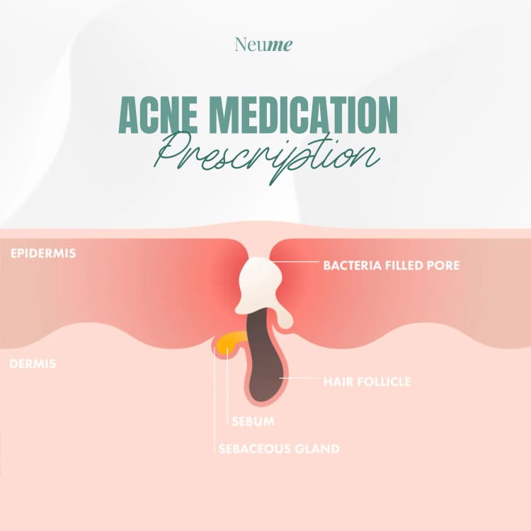 Acne Medication Prescription