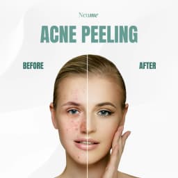 Acne Peeling