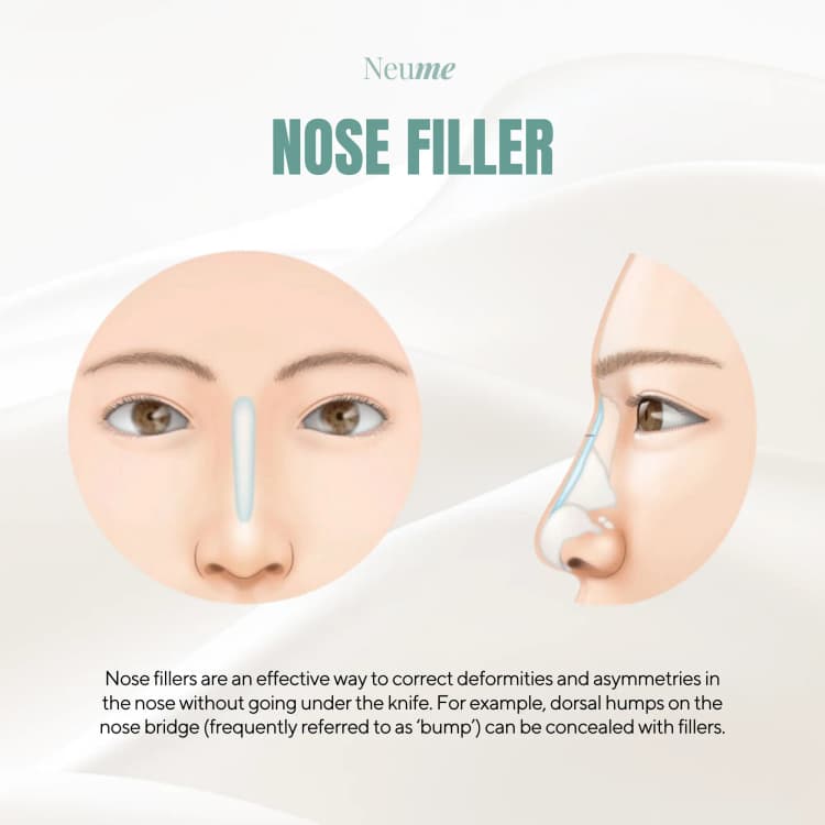 Nose Filler