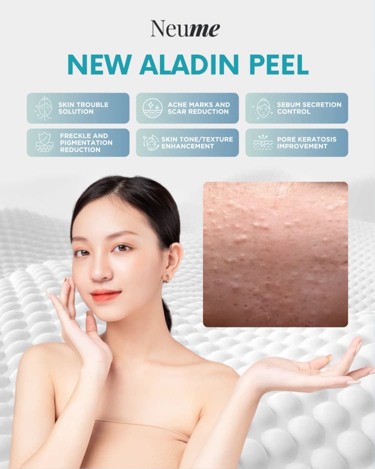 New Aladin Peel