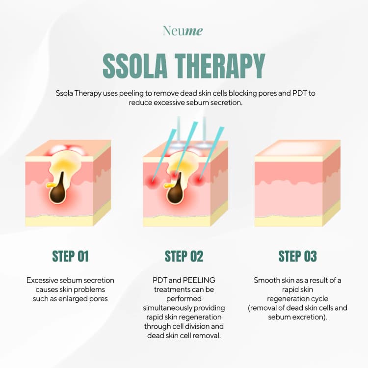 SSOLA Therapy