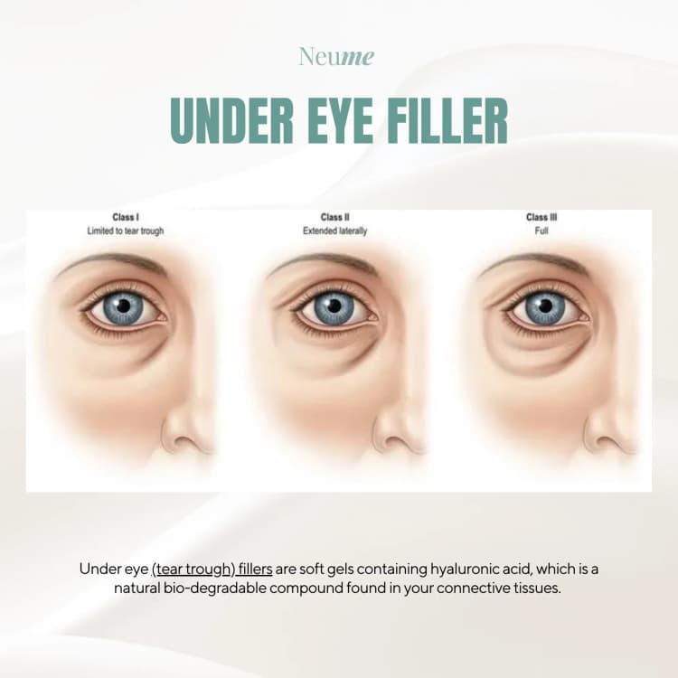 Under Eye Filler