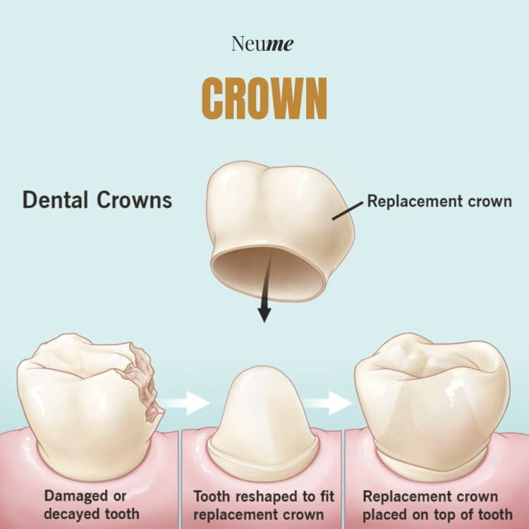 Crown