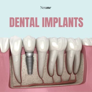 Dental Implants