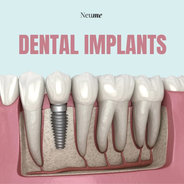 Dental Implants