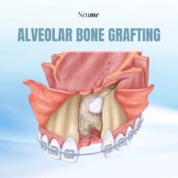 Alveolar Bone Grafting