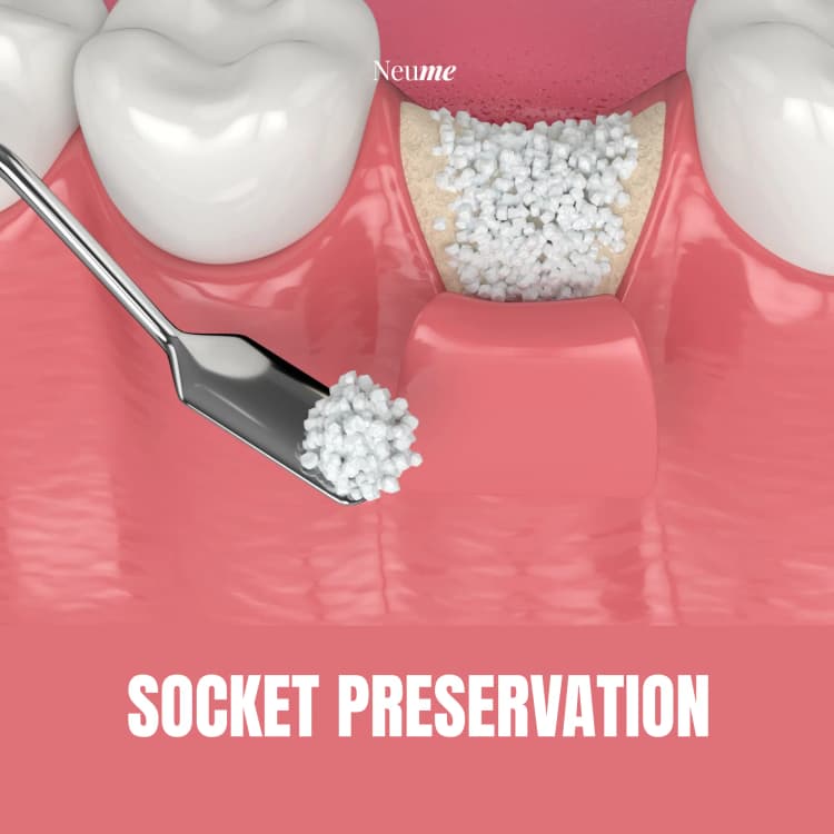 Socket Preservation