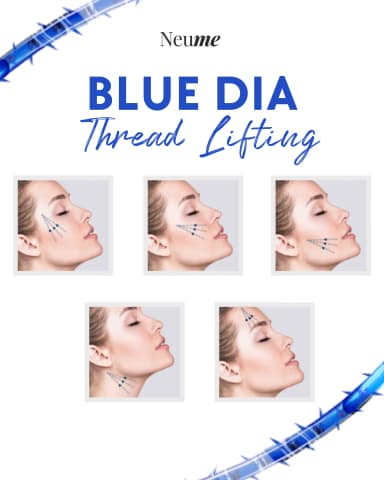 ブルーダイヤスレッドリフティング