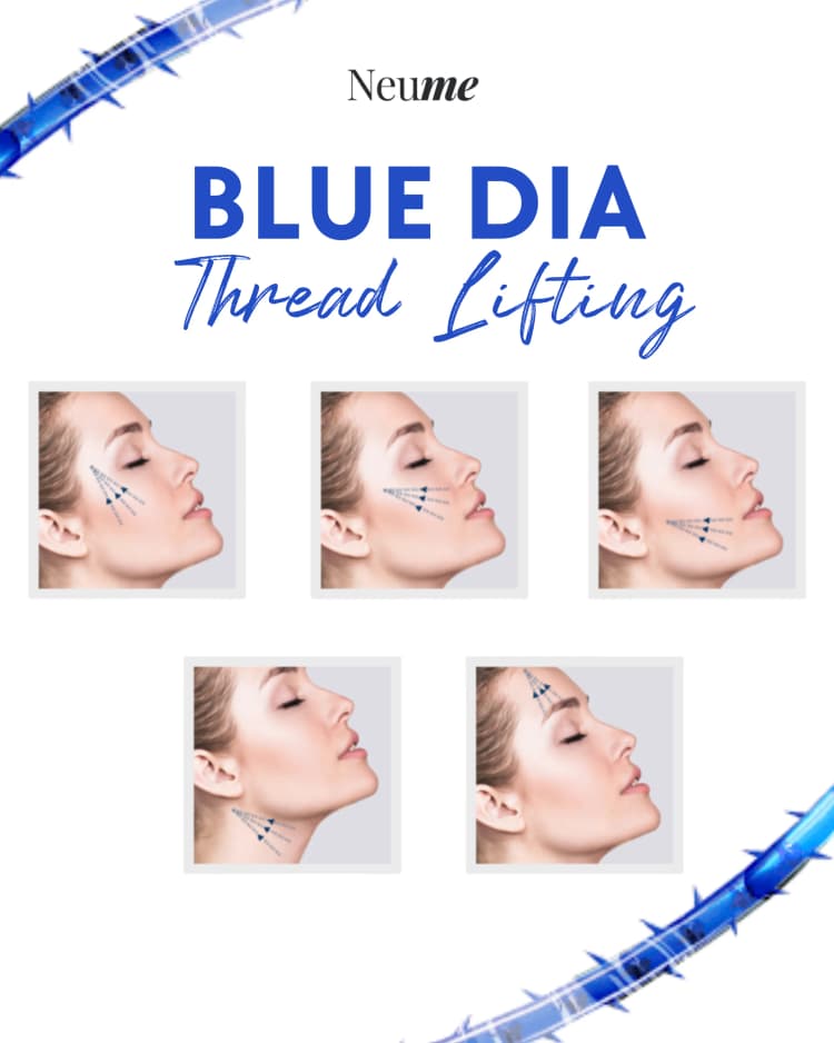 ブルーダイヤスレッドリフティング