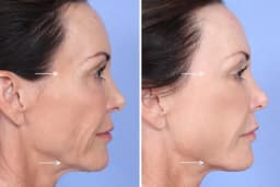https://neume-media-prod.s3.amazonaws.com/date=2025-07-29/1753777018859-Sculptra_Orange_County_Patient_1.webp