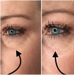 https://neume-media-prod.s3.amazonaws.com/date=2025-07-29/1753777411449-Undereye_filler_1_1013x1024.webp