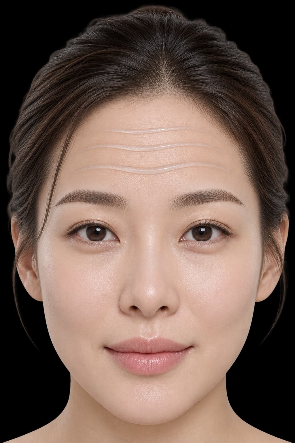 Skin Filler (Neck & Fine Lines)